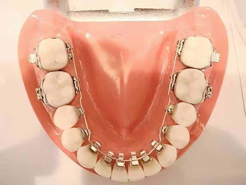牙齿矫正几个步骤？龅牙、牙齿不齐、地包天、虎牙…矫正需要多久