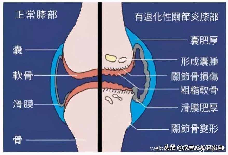 引发膝关节骨性关节炎的原因是什么？日常应该注意7方面