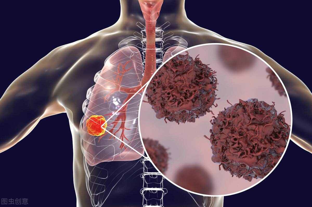 肺部肿瘤和肺癌的区别是什么？