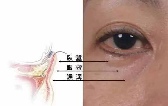 3种方法快速去泪沟 我更倾向第3种