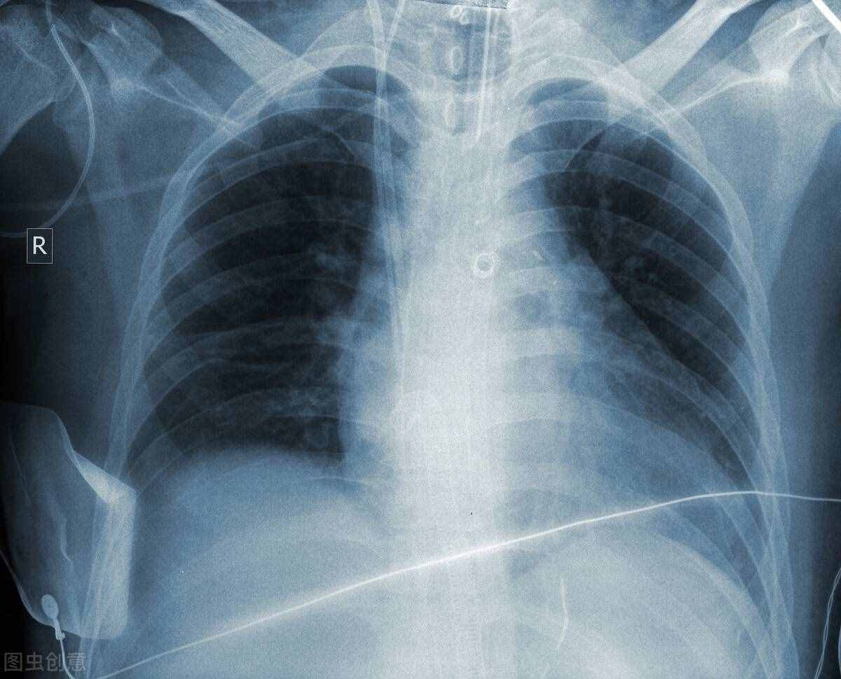 胸腔积液是怎么引起的？