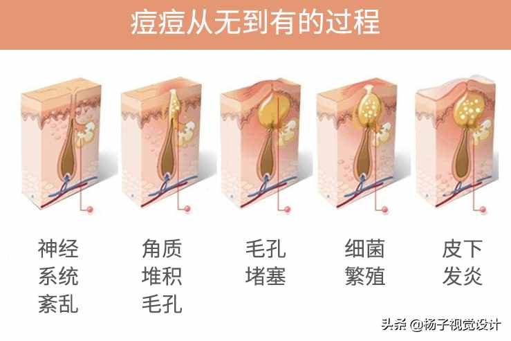 脸上长痘痘是因为什么原因引起的？怎么才能把脸洗干净？（图片）