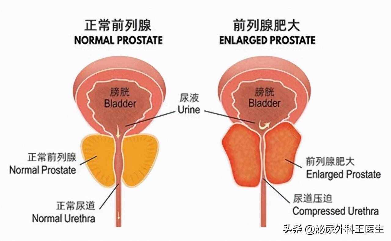 前列腺增生是怎么引发的？有什么表现？如何治疗与预防？