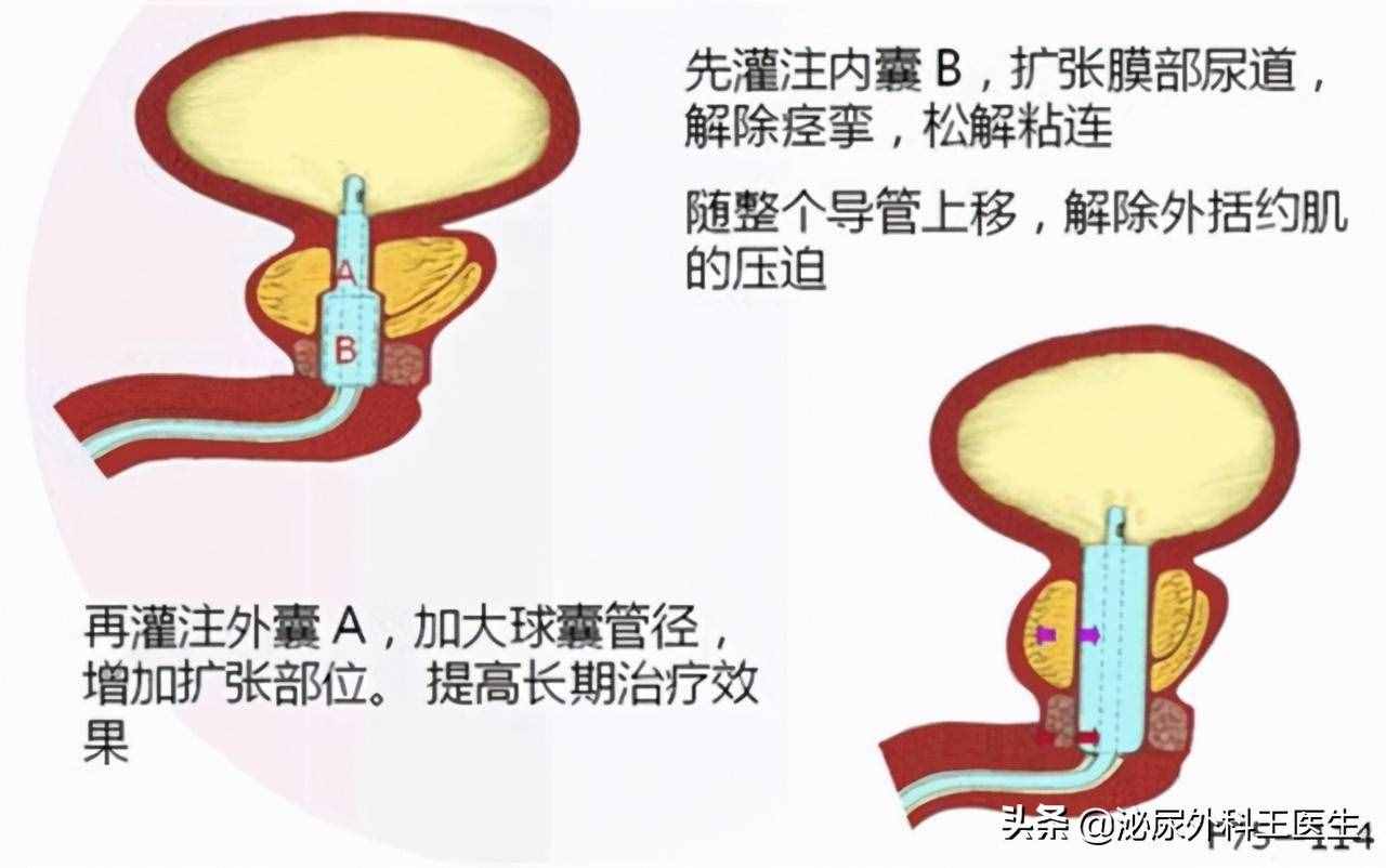 前列腺增生是怎么引发的？有什么表现？如何治疗与预防？