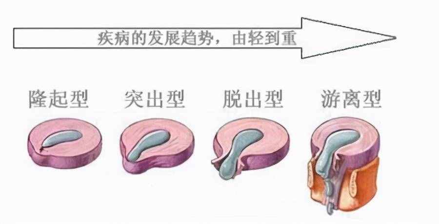 突出的椎间盘还能自己缩回去吗？靠按摩能按回去吗？