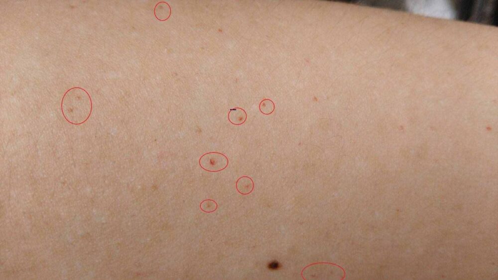 皮肤上的小红点别忽视，可能是癌症预兆！不疼不痒，仍要防4种病