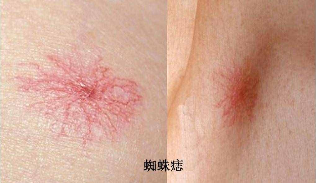 皮肤上的小红点别忽视，可能是癌症预兆！不疼不痒，仍要防4种病