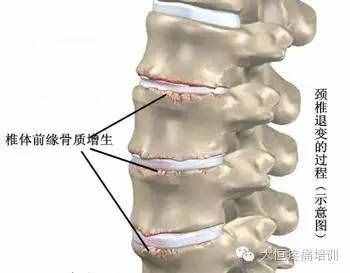 颈椎骨质增生该如何治疗才最好