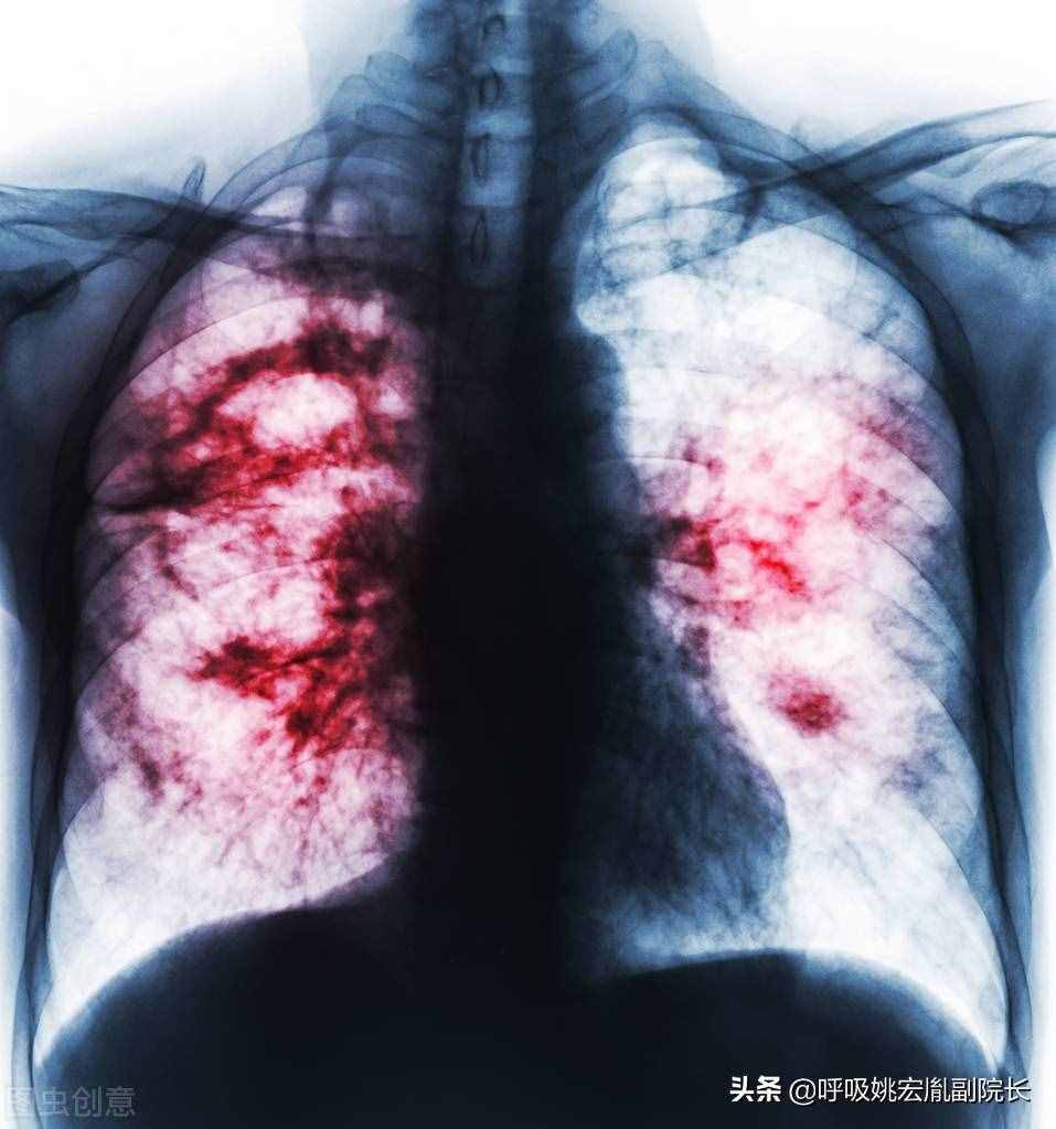 肺病有哪些？最常见的有这五种