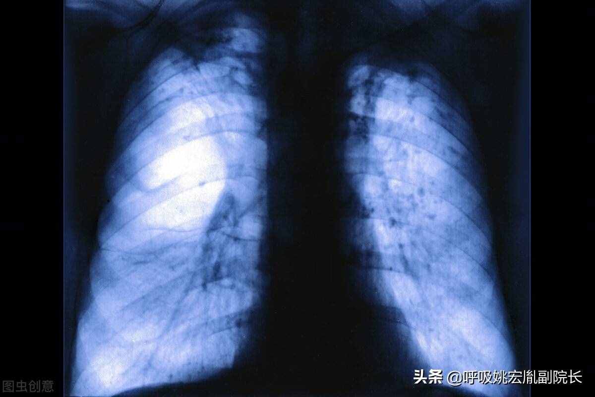 肺病有哪些？最常见的有这五种