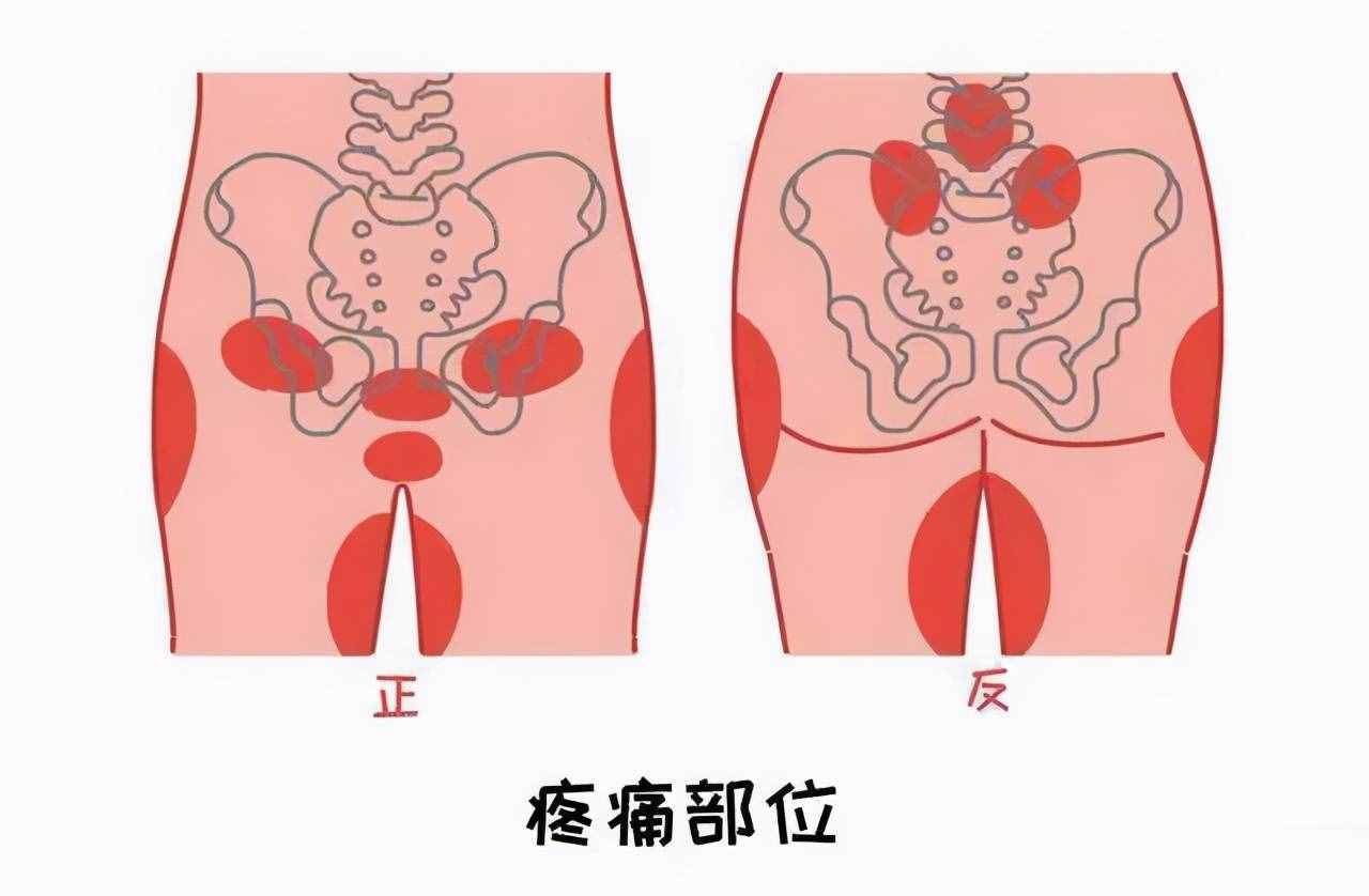 怎么就耻骨分离了？还疼痛难忍