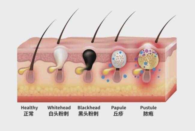 痤疮的治疗药物汇总，值得收藏