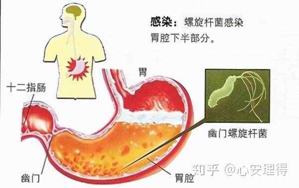 幽门螺旋杆菌之口臭篇