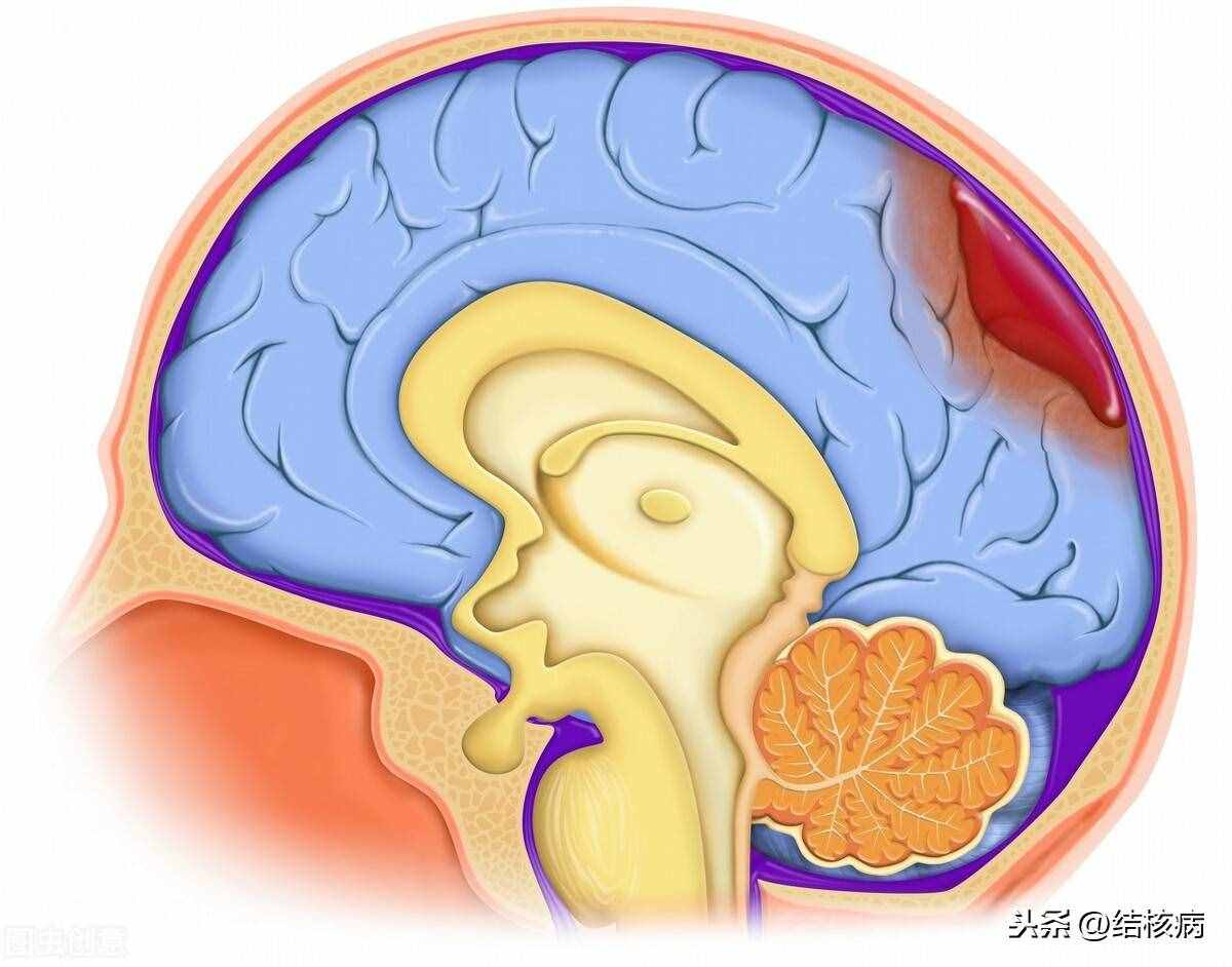 6种结核性脑膜炎的病理变化