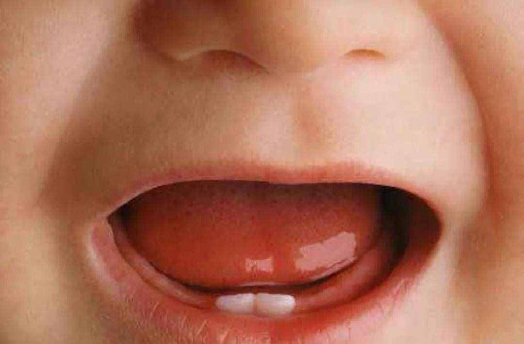 宝宝有以下症状可能是要长牙了