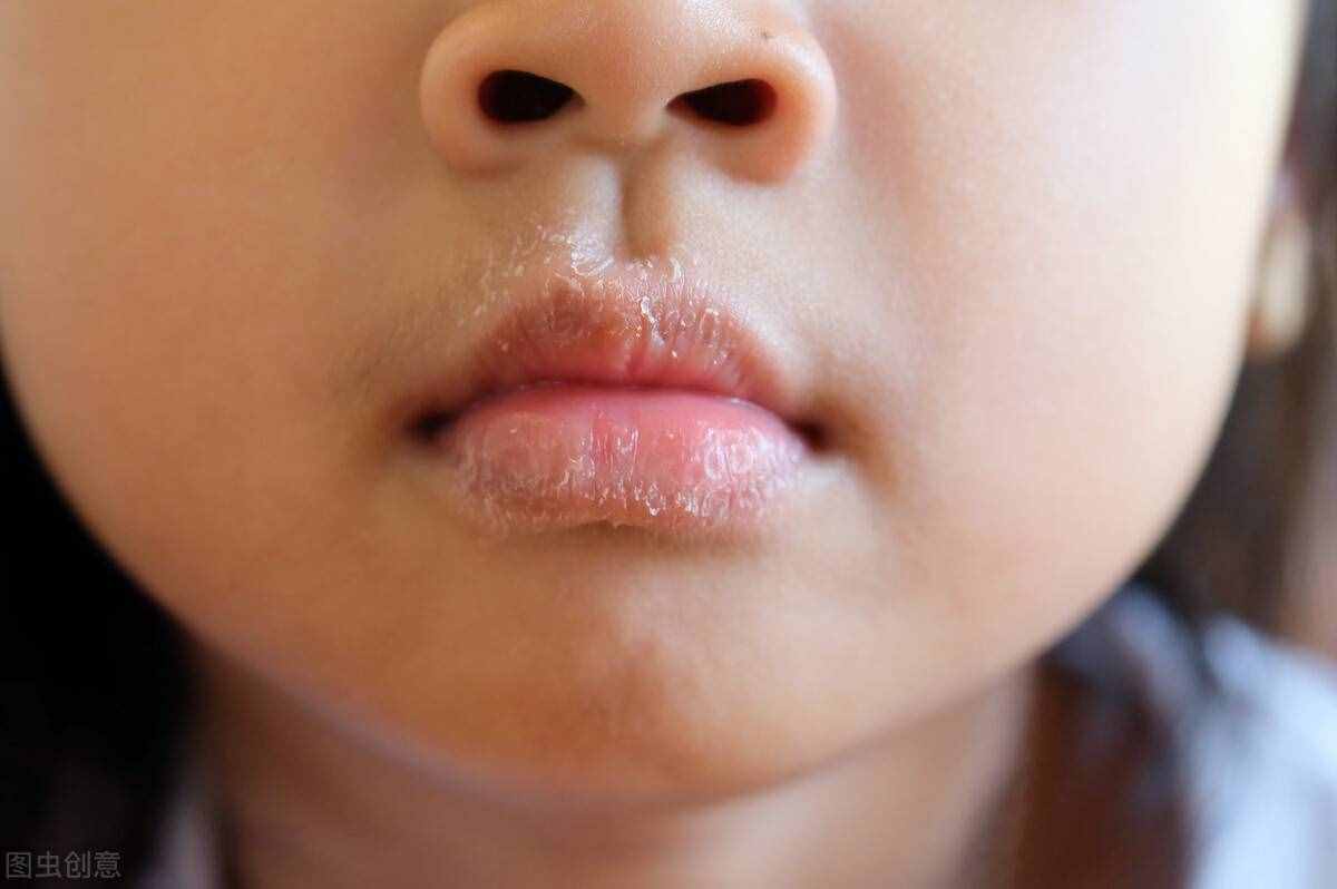 治疗唇炎，有效的措施有哪些，要注意什么？