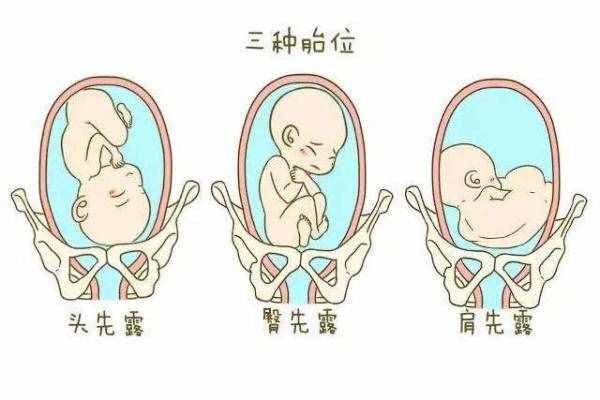 胎位不正是什么原因引起的？