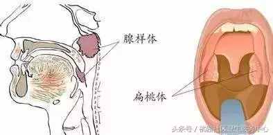 家长们注意了！孩子得了化脓性扁桃体炎怎么办？