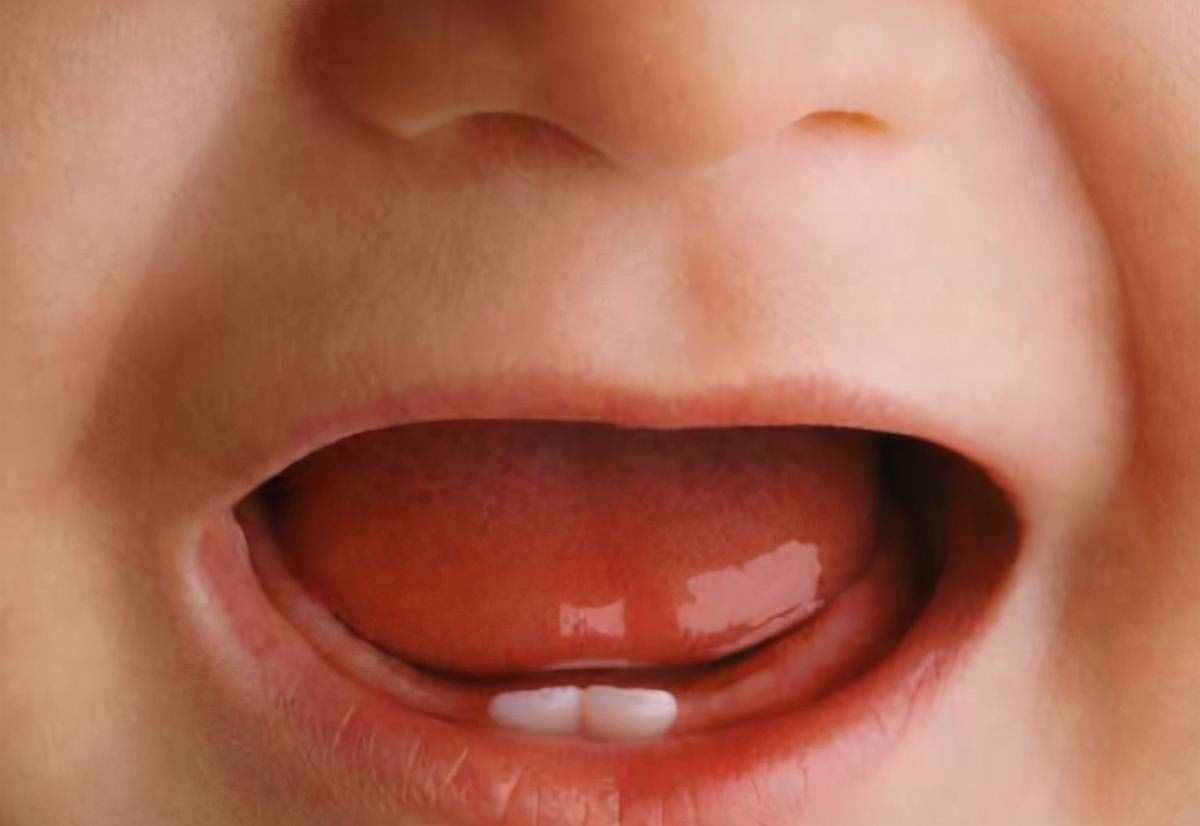 刚出生的宝宝居然有“2颗牙齿”？医生：拔掉吧