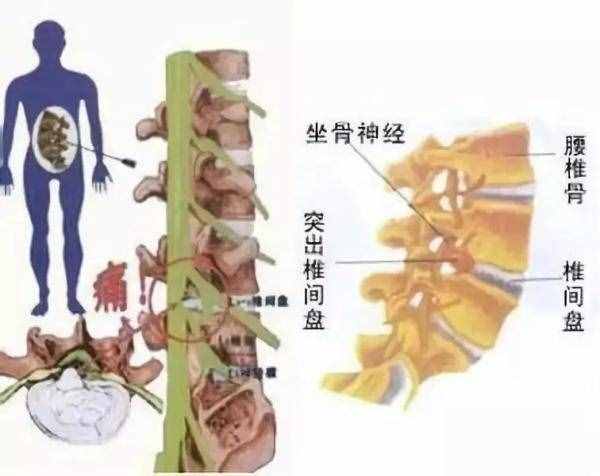 腰椎间盘突出如何自查？