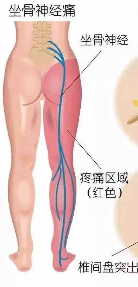 腰椎间盘突出如何自查？