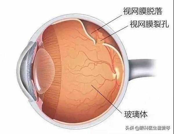 视网膜脱落的症状是什么？能不能完全治好？上海和平眼科告诉你