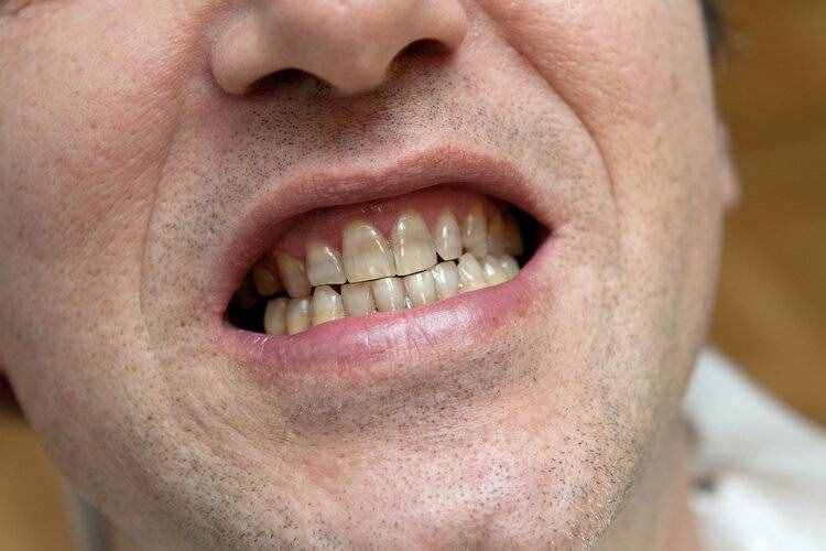 导致牙龈萎缩的7个原因，现在改正过来，老了依然有一口好牙