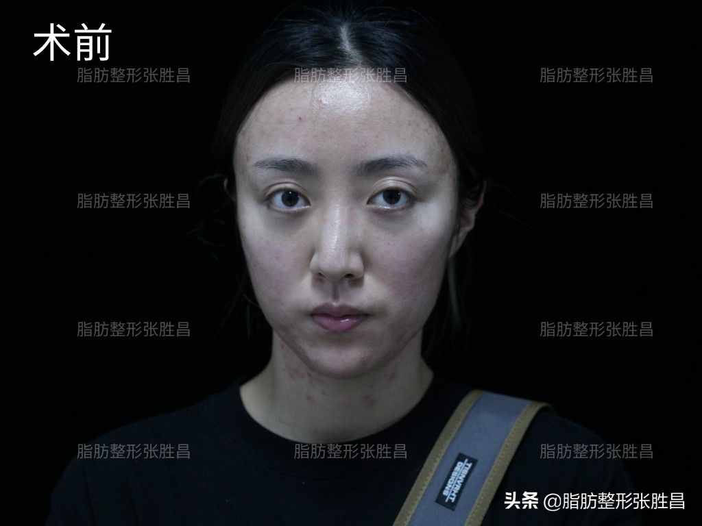 脸过瘦、尖下巴，28岁江苏女生曾打过玻尿酸，最后又来填充脂肪