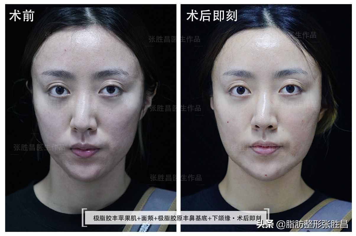 脸过瘦、尖下巴，28岁江苏女生曾打过玻尿酸，最后又来填充脂肪