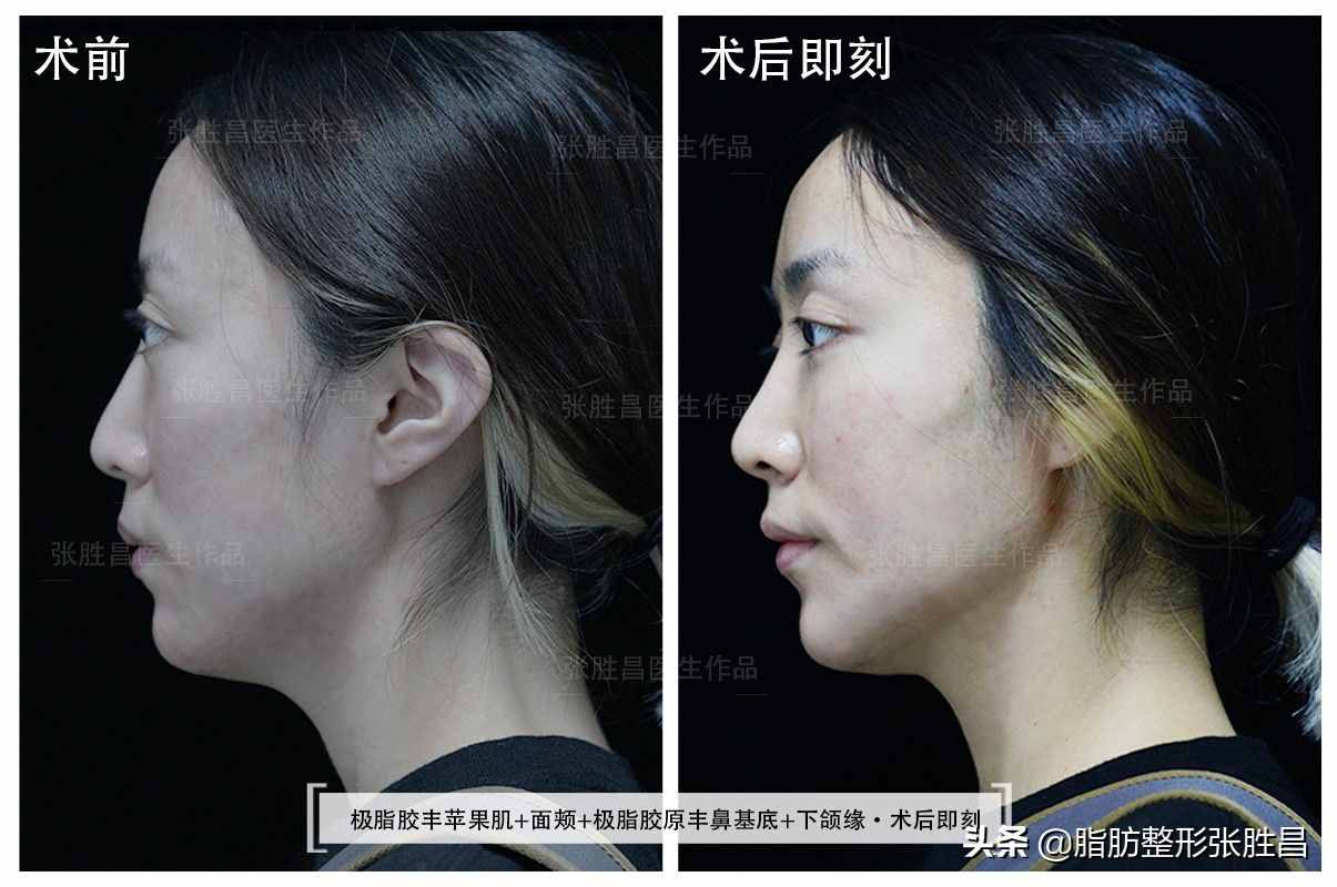 脸过瘦、尖下巴，28岁江苏女生曾打过玻尿酸，最后又来填充脂肪