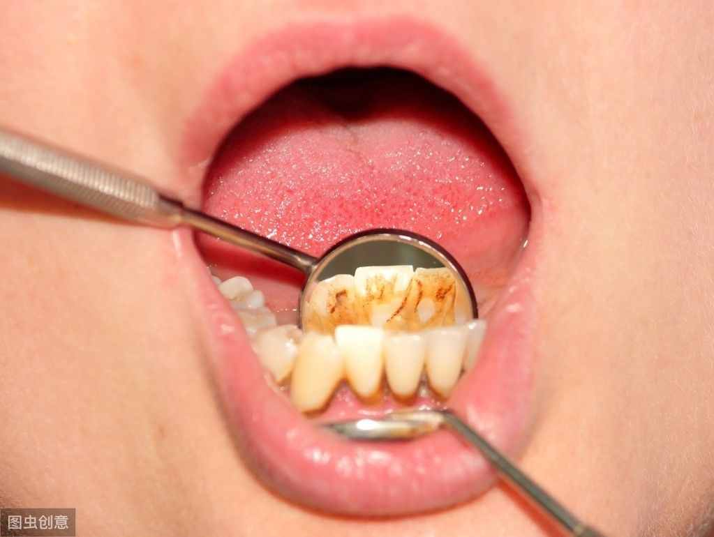 牙结石是如何形成的？带你揭秘牙结石形成的过程！早知道早预防