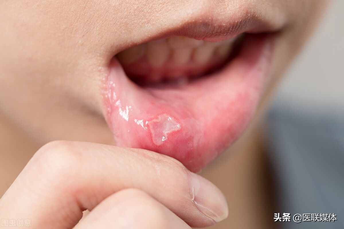 口腔溃疡发作，疼痛难忍要怎么办？为何口腔容易出现问题？