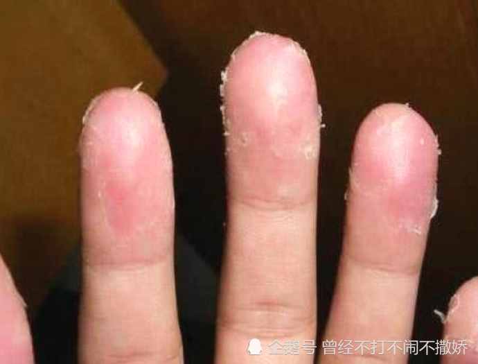 手指“脱皮”是什么造成的？八成是身体发出的求救信号，最好别大意