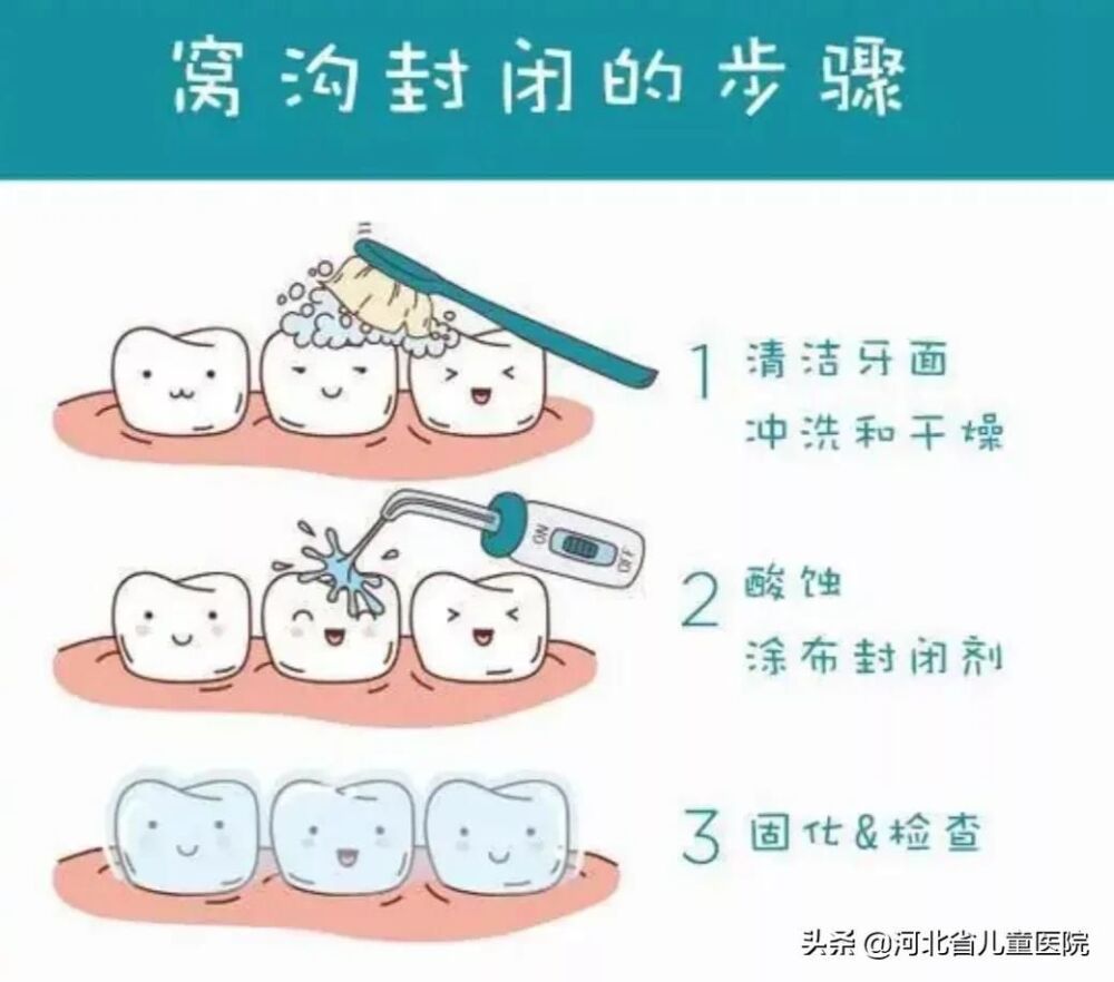 窝沟封闭，是怎样一种体验？