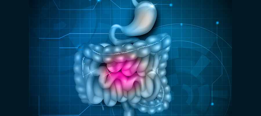 肠道炎症的12种原因和12种后果