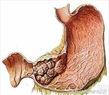 张锡纯，中西医结合大咖，他是如何治疗贲门癌、食管癌、胃癌的？