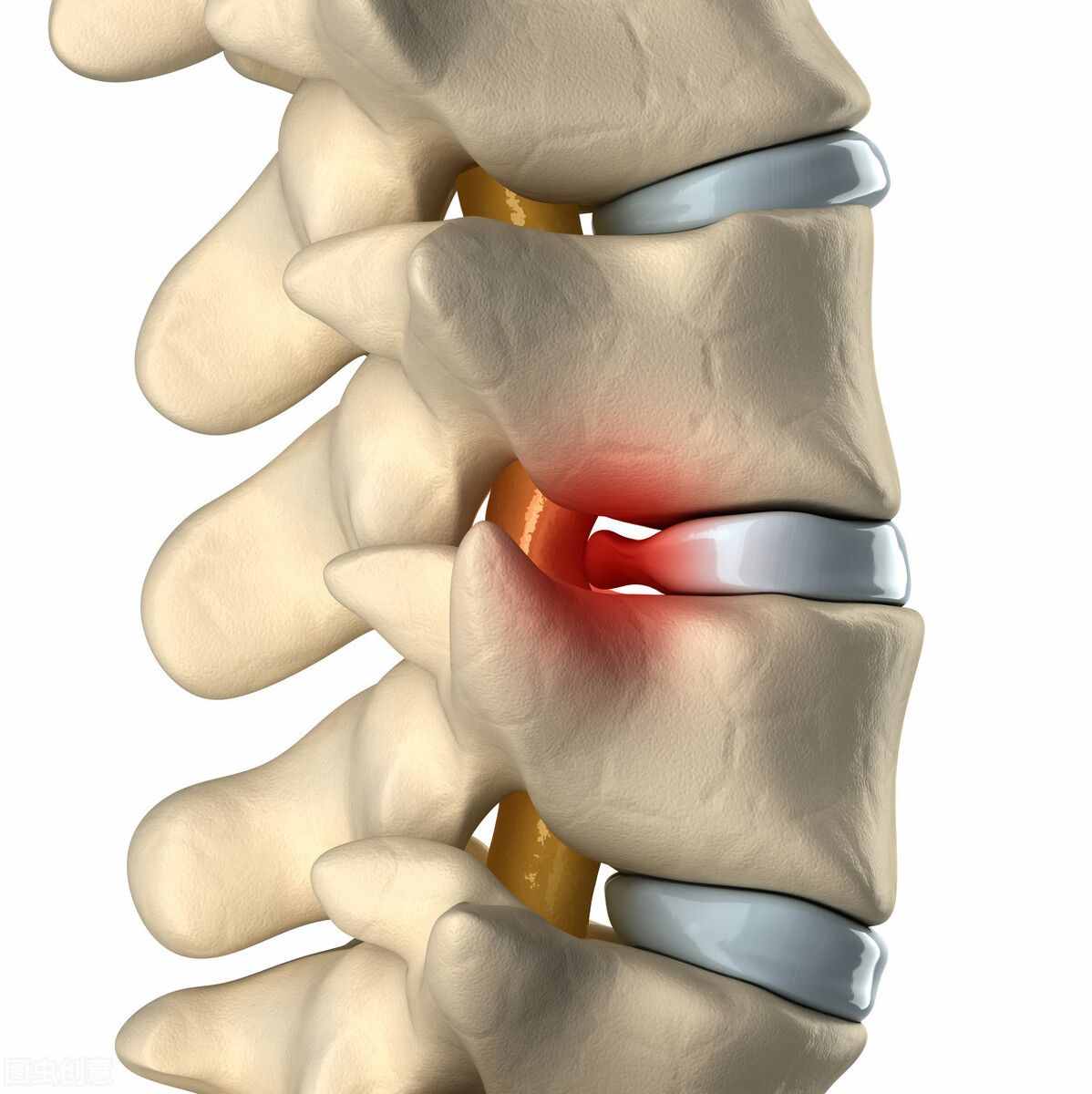 腰腿疼，有腰椎间盘突出症，该怎么治才能断根？医生介绍4种疗法