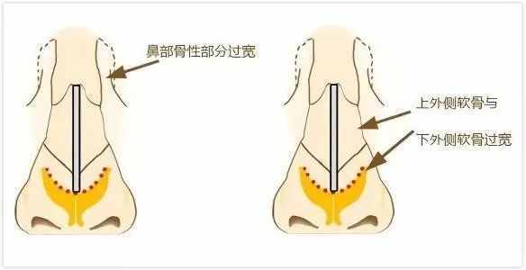 鼻子大、鼻子宽、这两种方式可以变小变窄