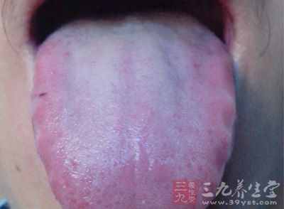 舌苔厚黄是怎么回事 看舌苔知身体状况