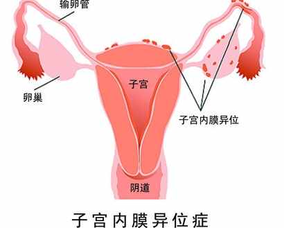 子宫内膜异位症的症状、诊断和预防，真正令人担心的是易造成不孕