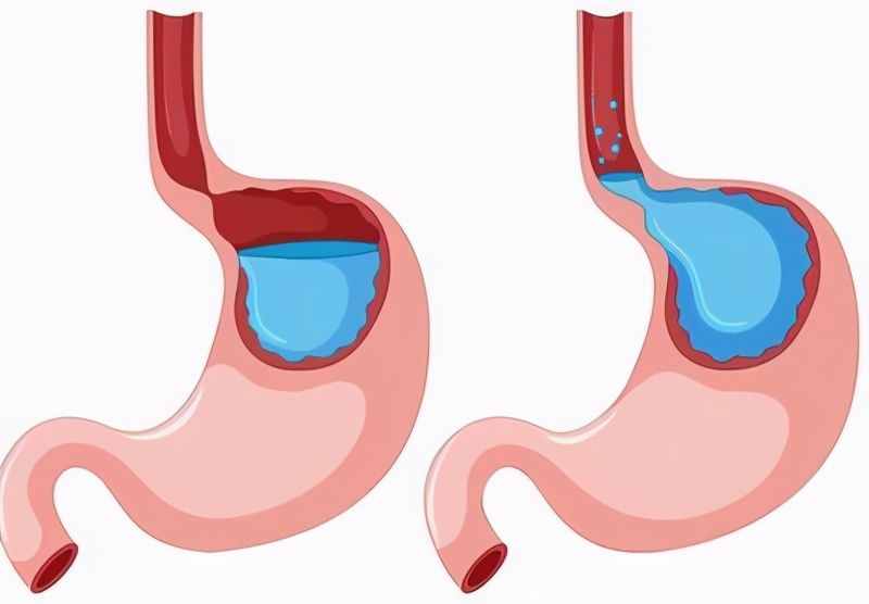 胃食管反流应该注意什么问题，胃食管反流，临床症状有哪些？