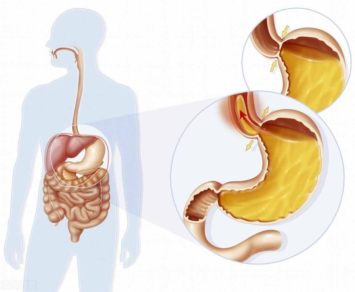 胃食管反流应该注意什么问题，胃食管反流，临床症状有哪些？