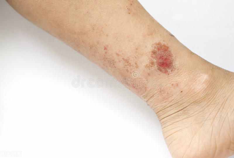 湿疹、皮肤瘙痒用什么药好得快？皮肤科医生的建议来啦