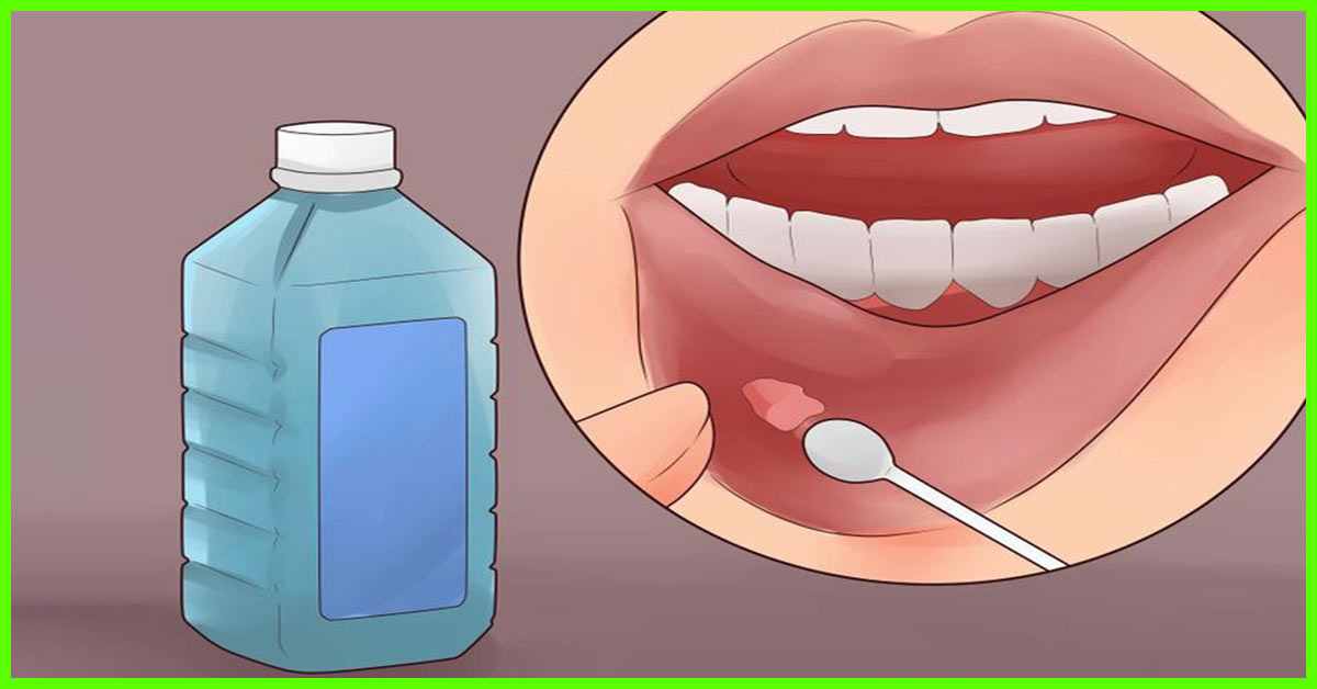口腔溃疡是缺乏维生素？贴维生素C片就能好？这些秘方真的可行吗