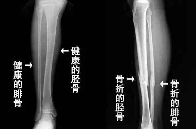 踢人不成自断腿，可能是一种“男科疾病”？