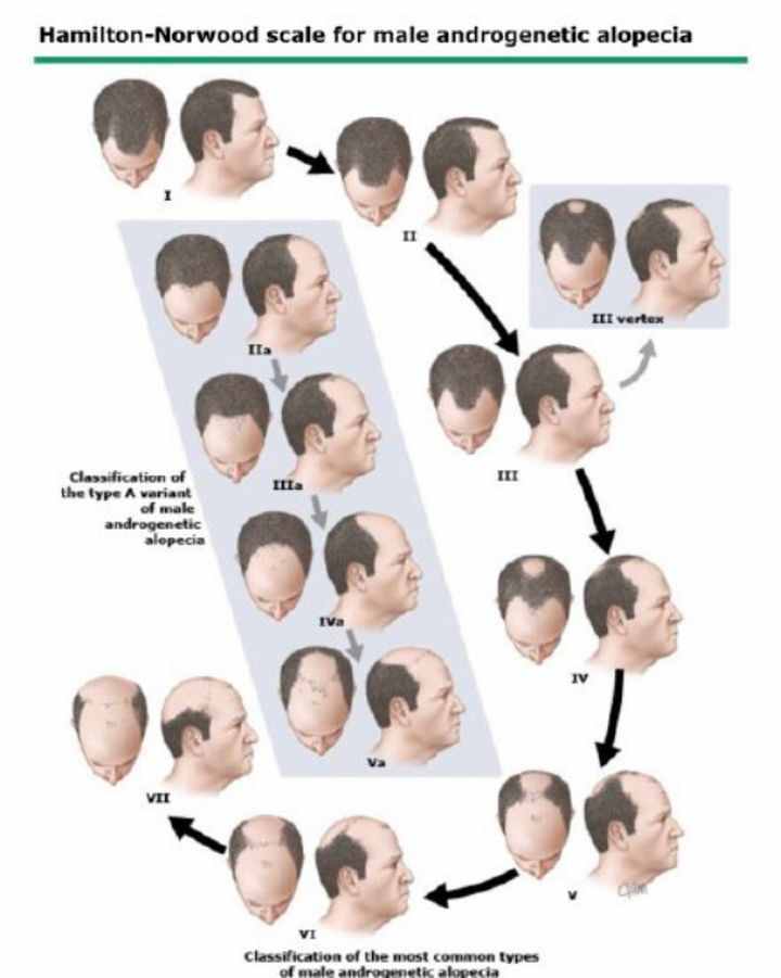 如何辨别自己脱发几级？这份脱发指南可一定得收藏好