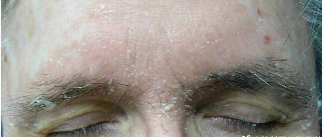 脂溢性皮炎治疗全攻略，眉间鼻翼不再泛红发痒