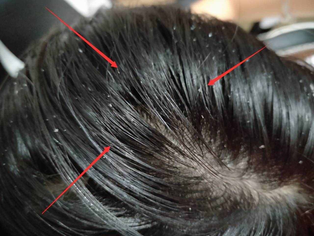 头发总是油腻腻？如何真正的实现头皮控油？