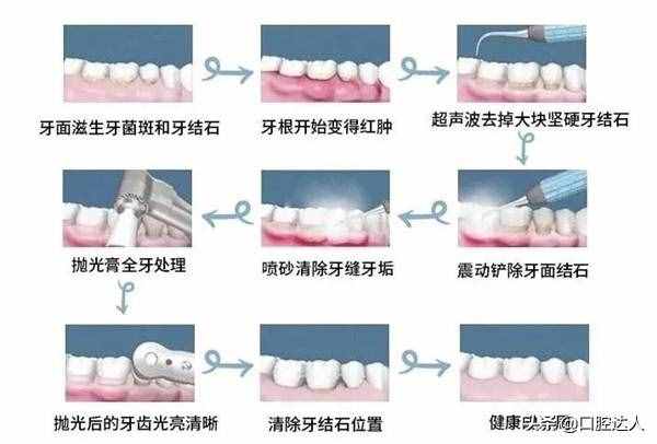 为什么说洗牙后牙齿会变白呢？