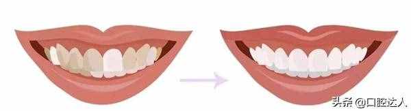 为什么说洗牙后牙齿会变白呢？